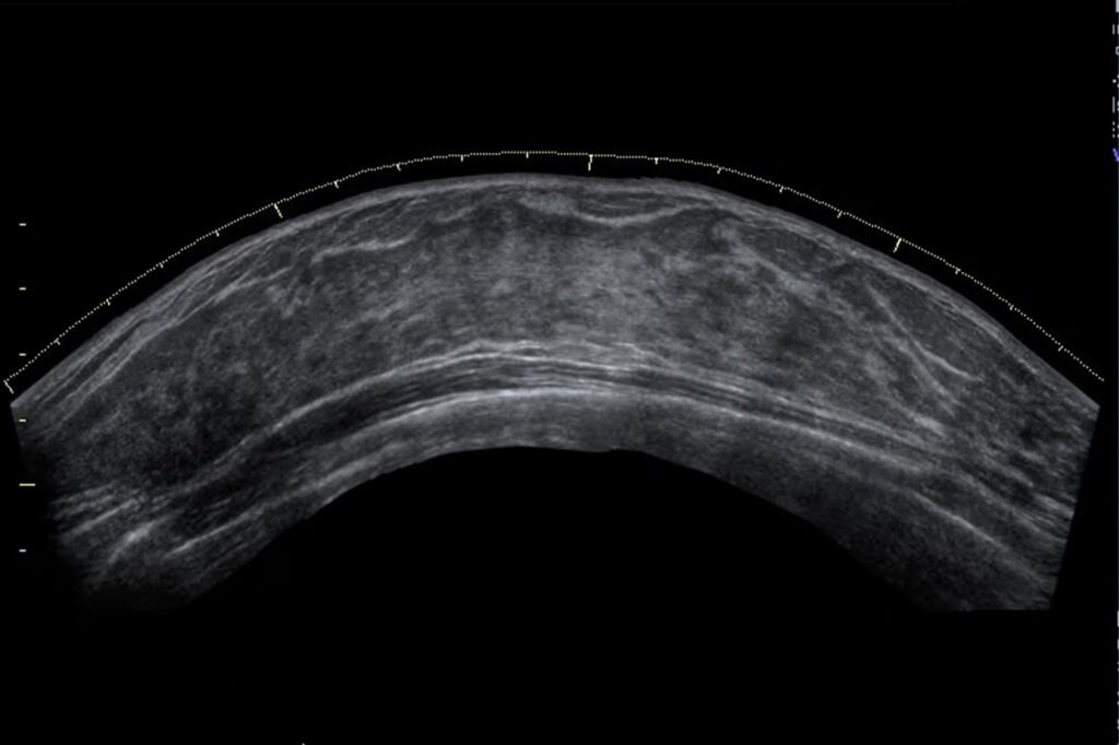 Imagem de ultrassom dermatológico mostrando as camadas da pele